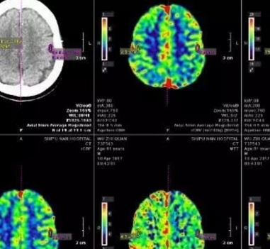 腦灌注ct影像處理軟件